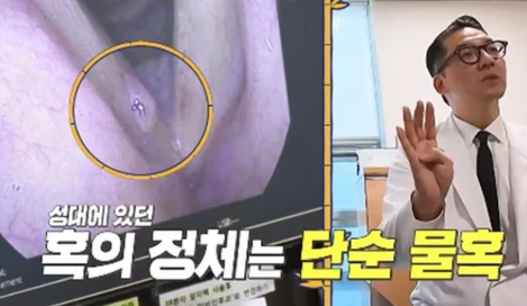 진성 물혹